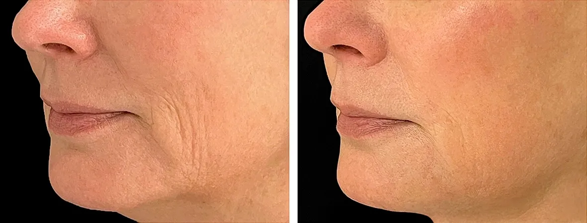 Before and after skin treatment comparison.