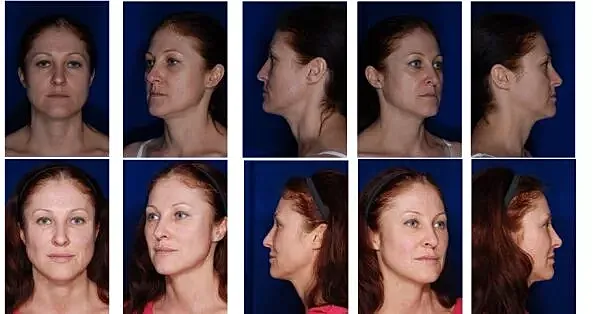 Before and after facial profile comparisons.