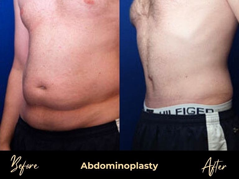 Abdominoplasty before and after transformation comparison.