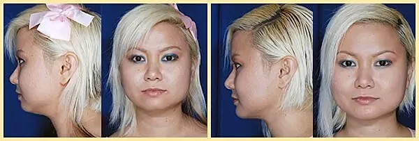 Before and after photos of facial transformation.