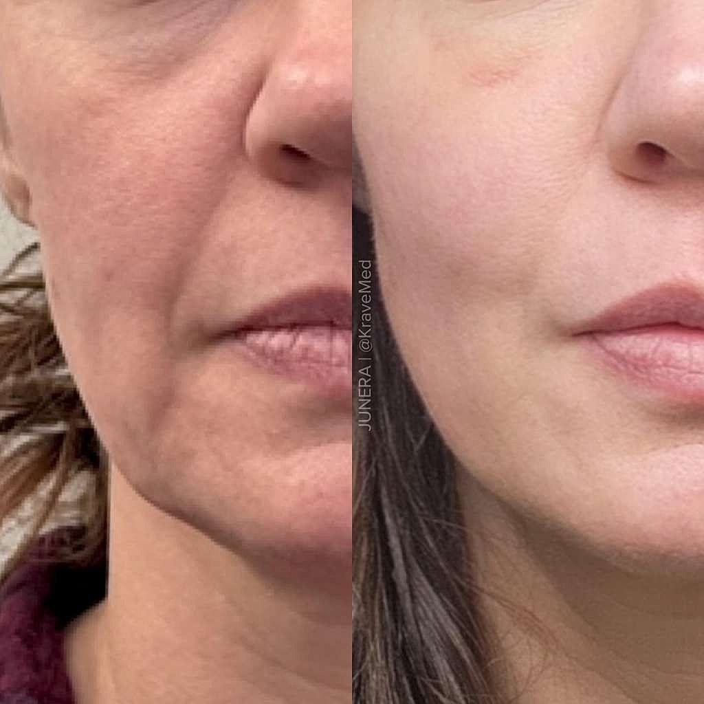 Before and after skin improvement comparison.