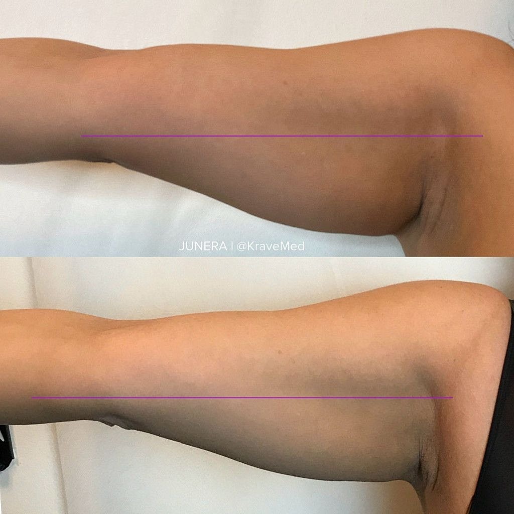 Before and after arm treatment comparison.