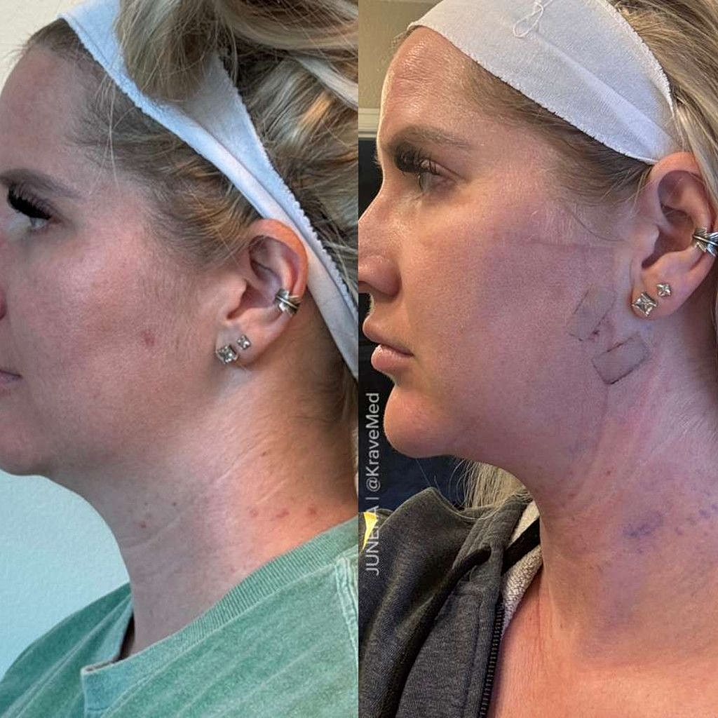 Before and after profile comparison of cosmetic procedure.