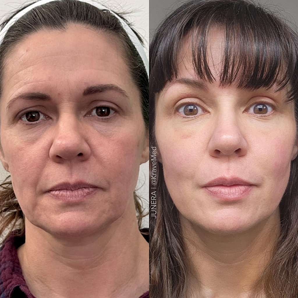 Before and after facial transformation comparison.