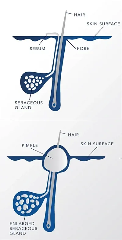 Sebaceous gland and pimple formation diagram.