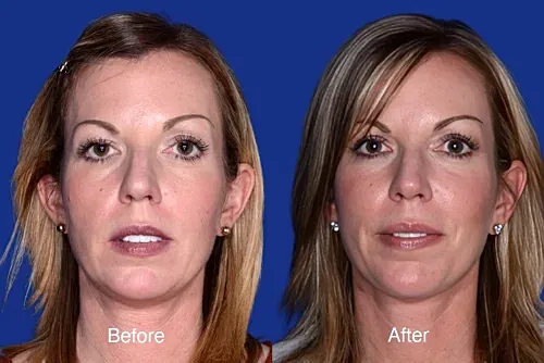 Before and after facial rejuvenation transformation.