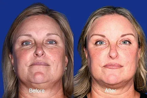 Before and after facial transformation comparison