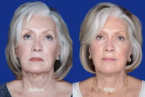 Before and after facial rejuvenation comparison.