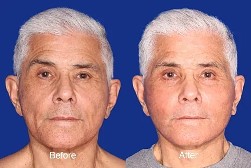 Before and after photos of facial treatment.
