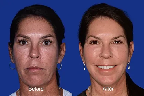 Before and after facial transformation comparison photo.