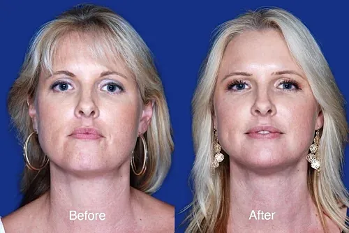 Before and after transformation photos of a woman.