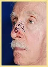 Skin cancer reconstruction surgical result on male patient's nose