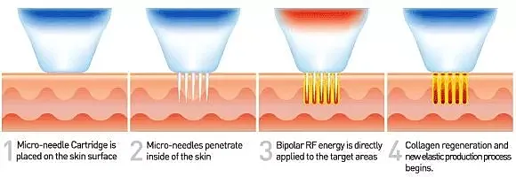 Secret RF microneedling treatment process showing cartridge placement, needle penetration, energy application, and collagen