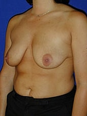 Breast Lift Before & After