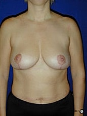 Breast Lift Before & After