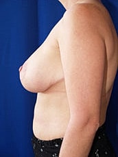 Breast Lift Before & After