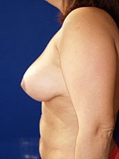 Breast Lift Before & After