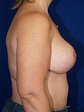 Breast Lift Before & After
