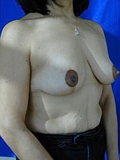 Breast Lift Before & After