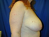 Breast Lift Before & After