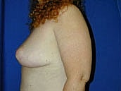 Breast Lift Before & After