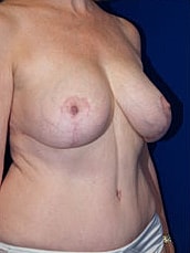Breast Lift Before & After