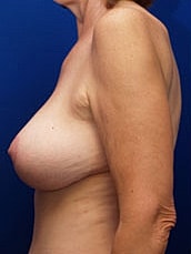 Breast Lift Before & After