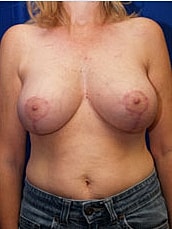 Breast Lift Before & After