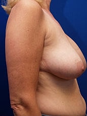 Breast Lift Before & After