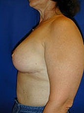 Breast Lift Before & After
