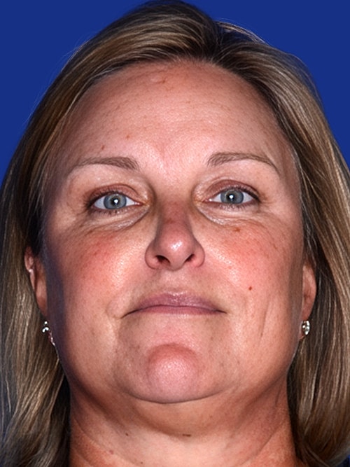 Brow Lift Before & After