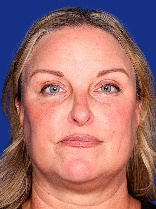 Brow Lift Before & After