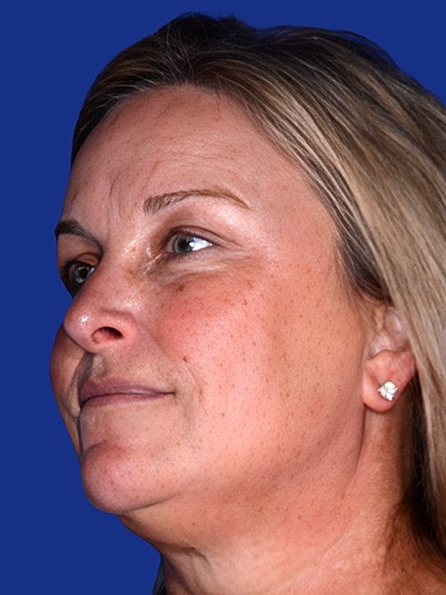 Brow Lift Before & After