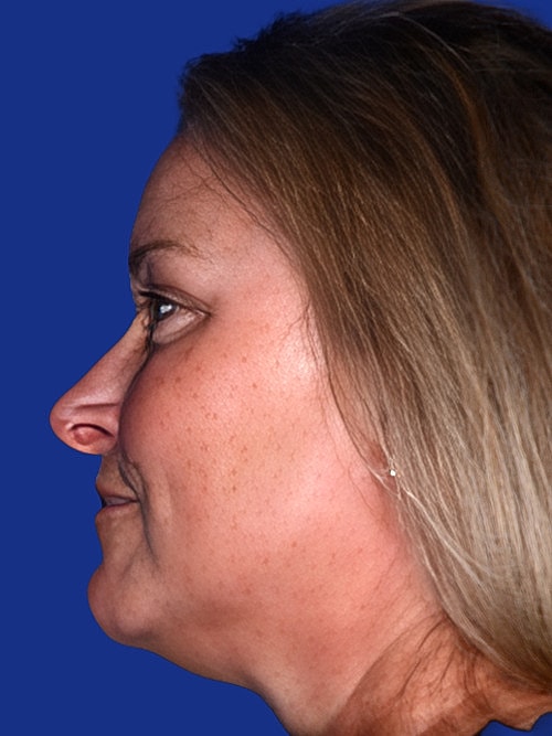 Brow Lift Before & After