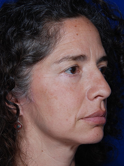 Brow Lift Before & After