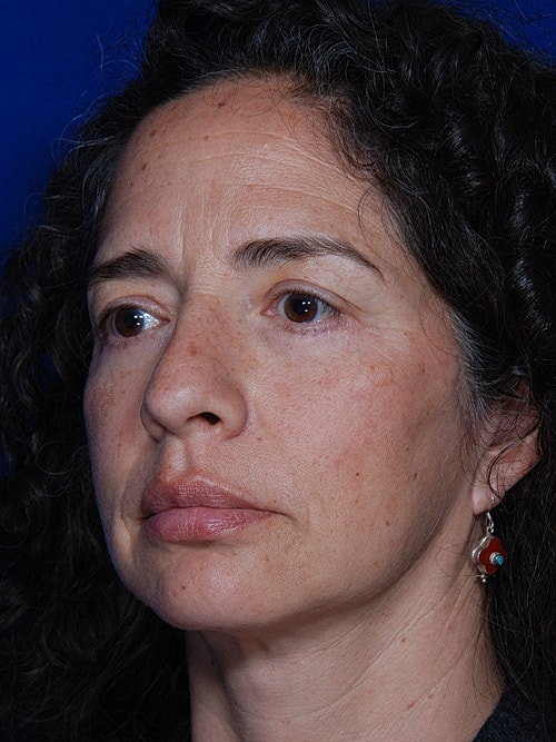 Brow Lift Before & After