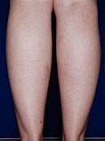Calf Ankle Liposuction Before & After