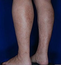 Calf Ankle Liposuction Before & After