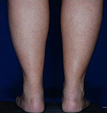 Calf Ankle Liposuction Before & After
