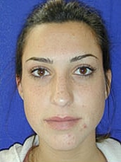 Rhinoplasty Before & After