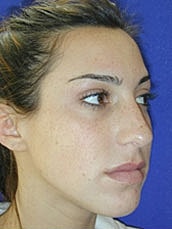 Rhinoplasty Before & After