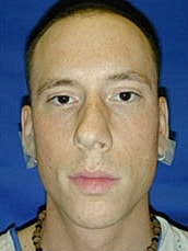 Rhinoplasty Before & After