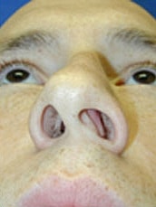 Rhinoplasty Before & After