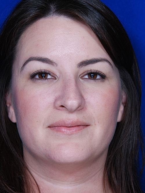 Rhinoplasty Before & After