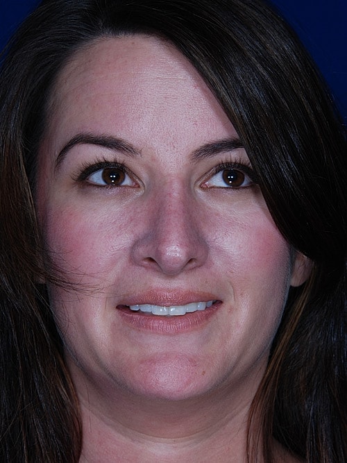 Rhinoplasty Before & After