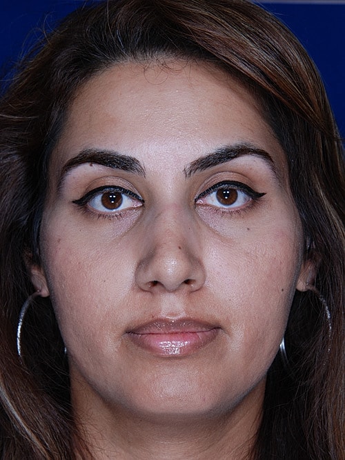 Rhinoplasty Before & After