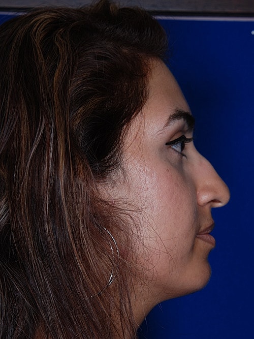Rhinoplasty Before & After