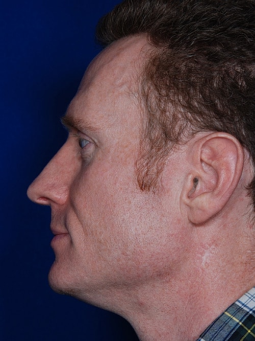 Rhinoplasty Before & After