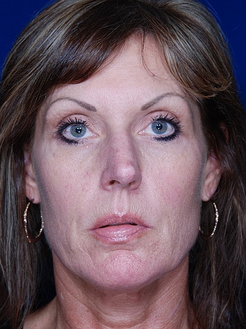 Rhinoplasty Before & After