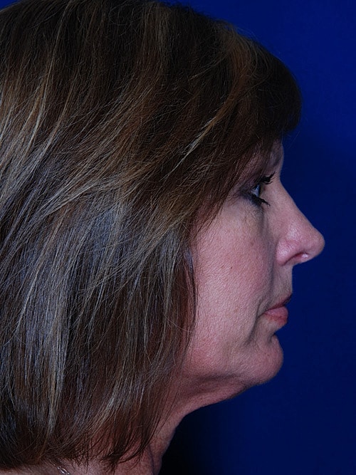 Rhinoplasty Before & After